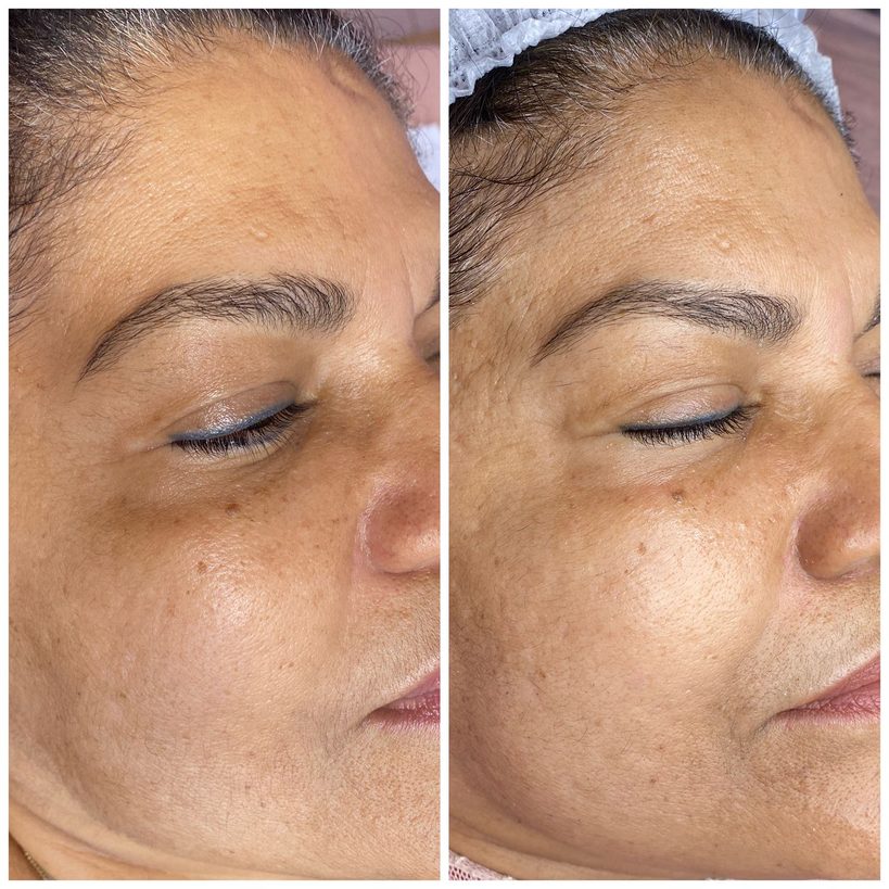 Antes e depois — Black Peel
